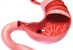 Viêm hang vị dạ dày: Nguyên nhân, triệu chứng và cách điều trị